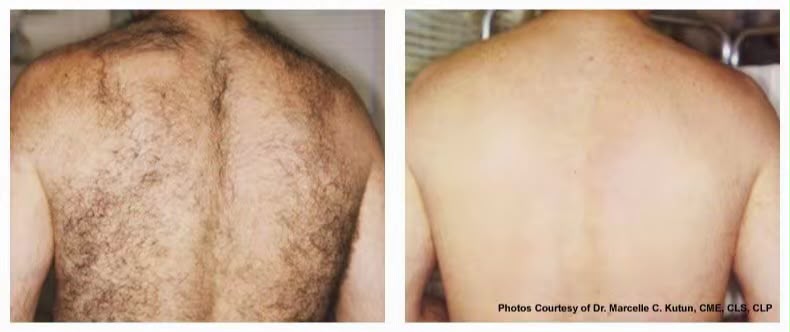 Before and after laser hair reduction result for the back