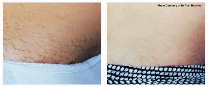 Before and after laser hair reduction result for the bikini area