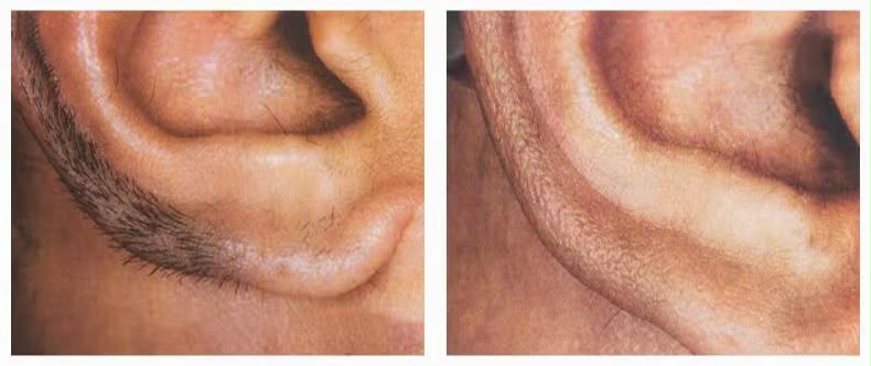 Before and after laser hair reduction result for the ear