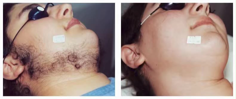 Before and after laser hair reduction result for facial hair