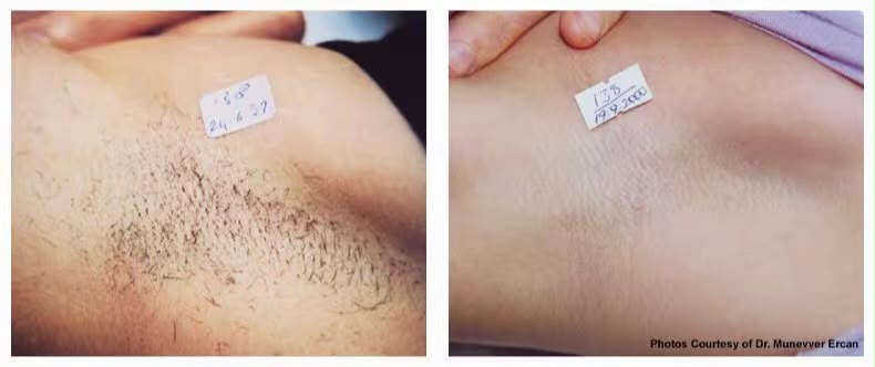 Before and after laser hair reduction result for the underarm area